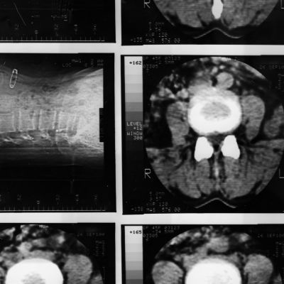 Traumatic Brain Injury Lawyer SAN DIEGO CA Gingery Hammer Schneiderman LLP